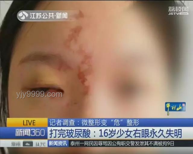 女子右眼狂飙泪：泪囊肿瘤背后的诊疗故事